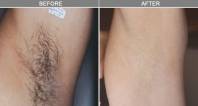 Chicago Laser Hair Removal